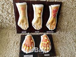 Lot Bleach Wax Medical Models Moulage Chemical Warfare Mustard Gas 50s Halloween